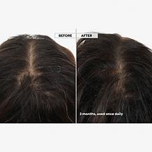 Keranique 120-Day Hair Regrowth Bundle Auto-Ship®