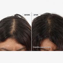 Keranique 120 Day Hair Regrowth Bundle