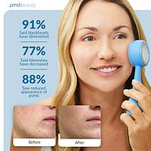PMD Clean Acne Smart Facial Cleansing Device