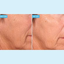 SKINN 2-pack Deep Wrinkle Protocol Creme Reverse