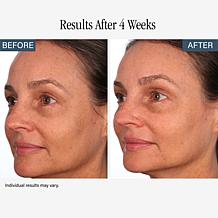 SKINN Non-Negotiables Multi-Acid Resurfacing Pads and Headband Duo