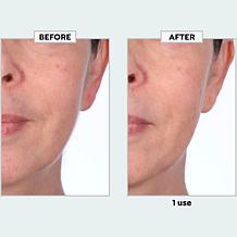 TruRitl Dermaplane Set w Bag