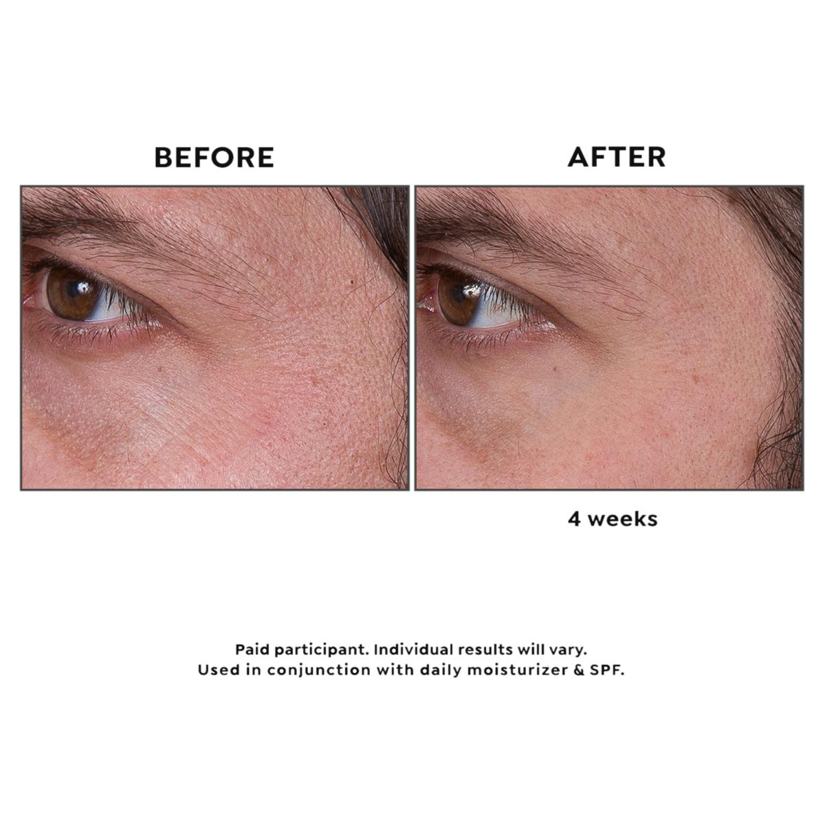 [値下げ]BEAUTYBIO GloPRO® At-Home Microneedling Regeneration Tool | BeautyBio